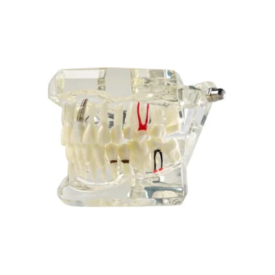 Evodent all in one dental model showing three integrated implants for clinical education designed for implant procedure simulation and anatomical visualization