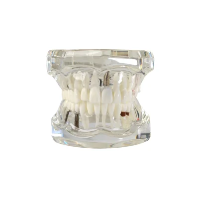 Evodent all in one with three implant