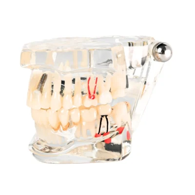 Evodent All in One Dental Featuring Three Implant with Fixed Partial Denture Used For Dental Training and Patient Education