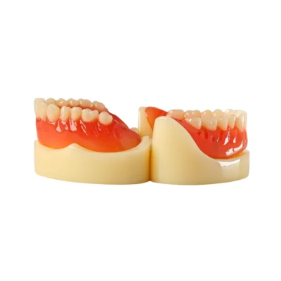 Evodent Full Denture with Implant Model Showing Compleate Upper and Lower Dentures Supported Dental Implants.