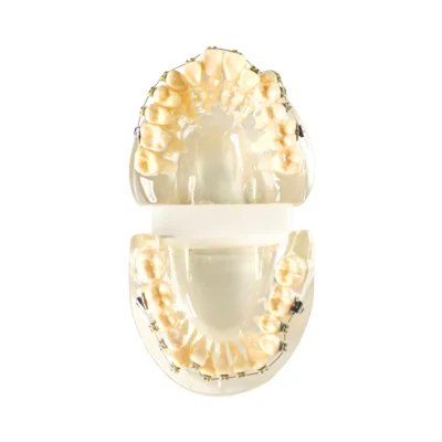 Evodent Molocculation Model with Metal Bracket Clear Evodent Molocculation Model with Metal Bracket Clear