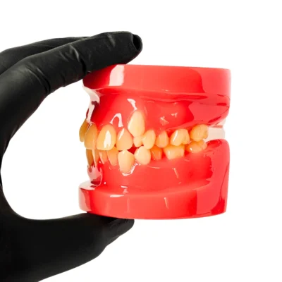 Evodent Orthodontic Model Class I Malocclusion Pink