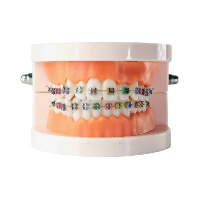 Evodent Orthodontic Model with Metal Bracket Show each Tooth Fitted with Stainless Steel Metal and Mounted With Upper and Lower.