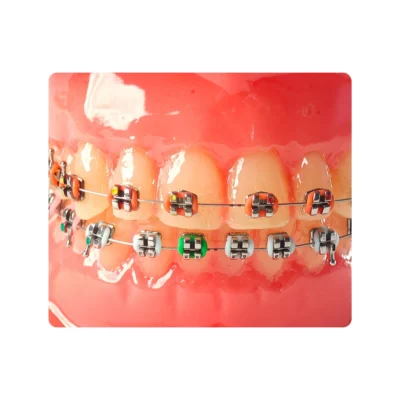 Evodent Orthodontic Model with Metal Bracket