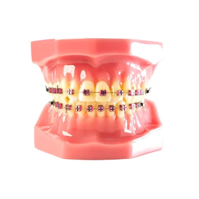 Evodent Orthodontic Model with Metal Bracket Pink Used for pre-clinical dental education and hands-on orthodontic practice