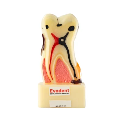 Evodent Periodontal Disease Model with Tooth Cross Section Showing With Detailed Gum Recession and Bone Loss Infection For Dental