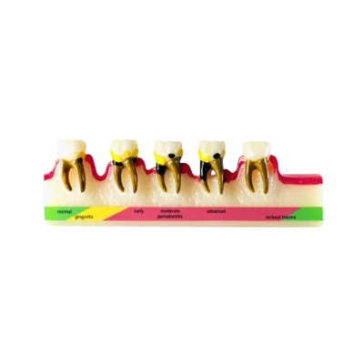 Evodent Periodontal Disease Stages Model Displaying Different Stages of Disease and Bone Loss from Healthy Gums.
