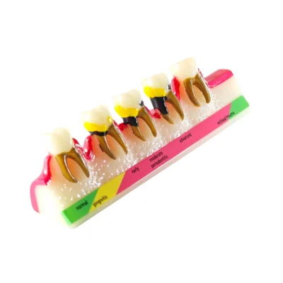 Evodent Periodontal Disease Stages Model