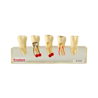 Evodent RCT Treatment Model Showing Tooth Structure With Root Canal Access and Pulp Chamber, Filling Material