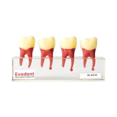 Evodent RCT Treatment Model Showing Root Canal and Post Placement Inside Treated Tooth for Dental Training.