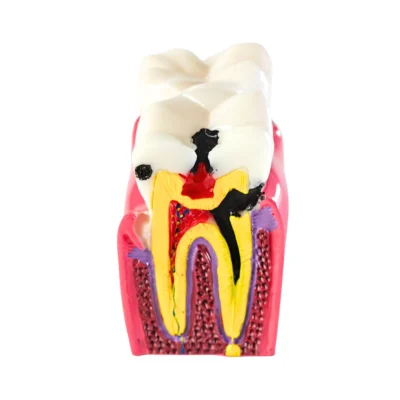 Evodent Tooth Decay Cross Section Comparison Showing Healthy Tooth and Caries Progression