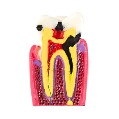 Evodent Tooth Decay Cross Section Comparison